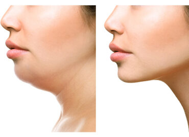 DOUBLE-CHIN-REDUCTION