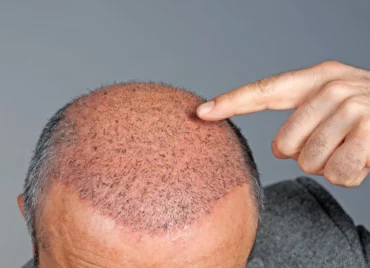 Hair-Transplantation-Therapy