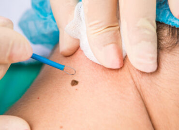 mole-removal