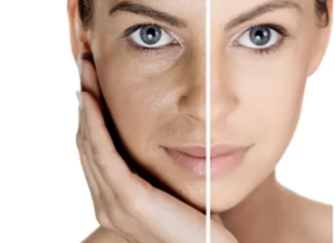 skin-whitening-treatment-500x500